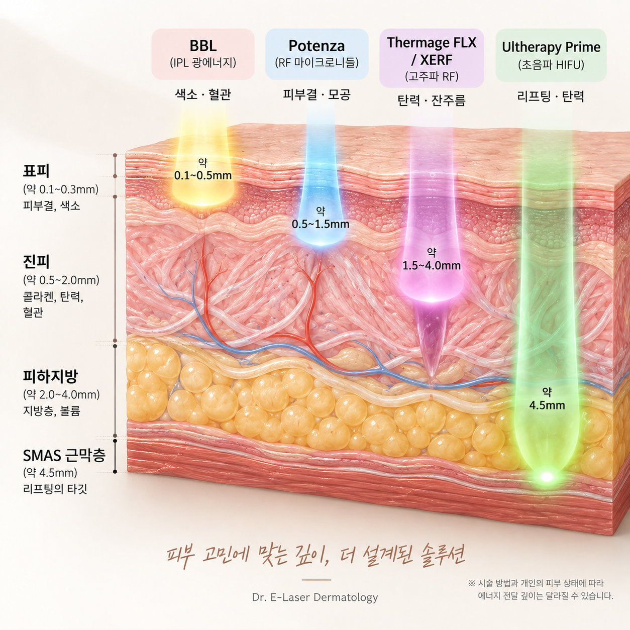 리프팅 에너지가 전달되는 피부층 구조