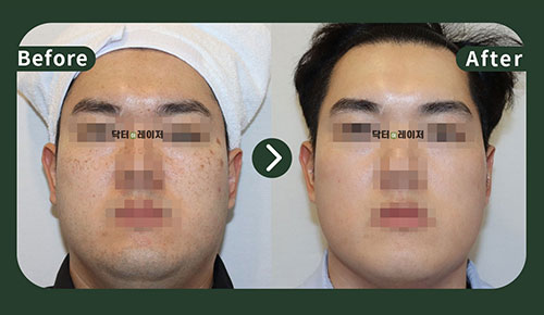 [잡티] 30대 전후사진