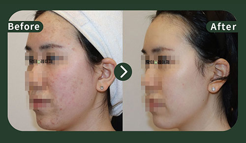 [여드름] 20대 전후사진