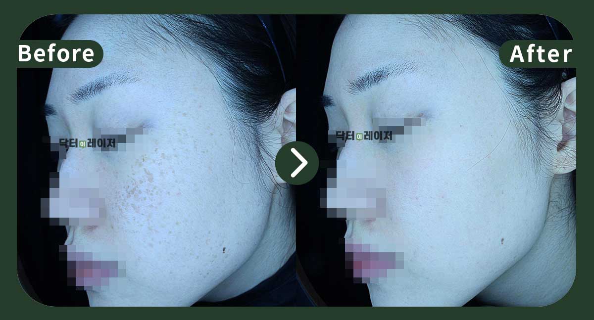 [잡티+주근깨] 30대 전후사진
