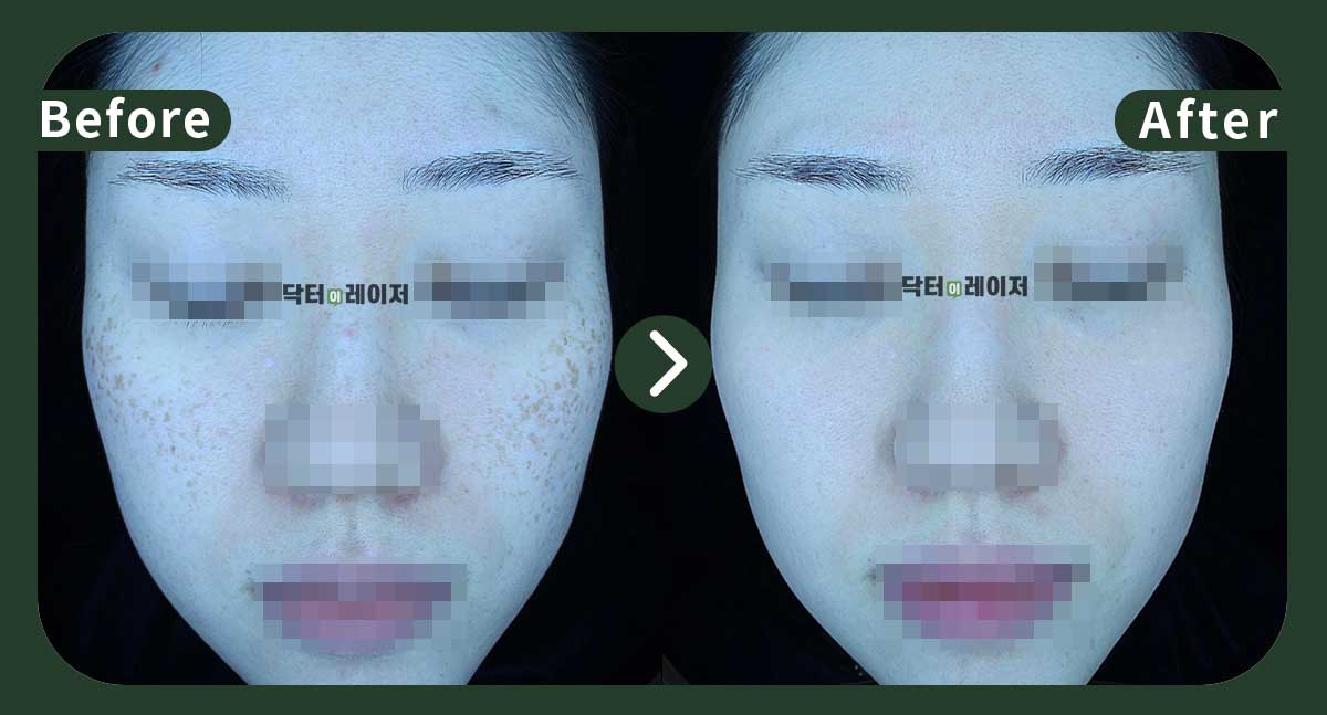 [잡티+주근깨] 30대 전후사진